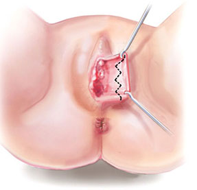 Labiaplasty-longitudinal-resection-technique